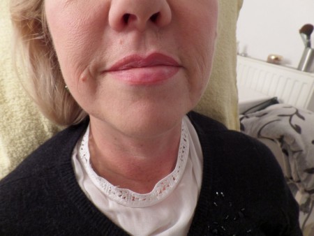 Sehr vorsichtige Korrektur einer natürlichen Lippenfehlstellung